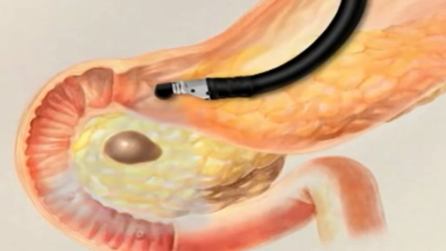 State of the art cancer-screening technology arrives in Siouxland